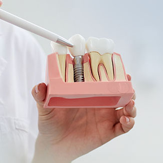 Model of dental implant